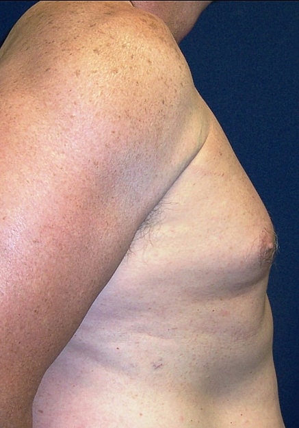 Male Breast Reduction Before & After