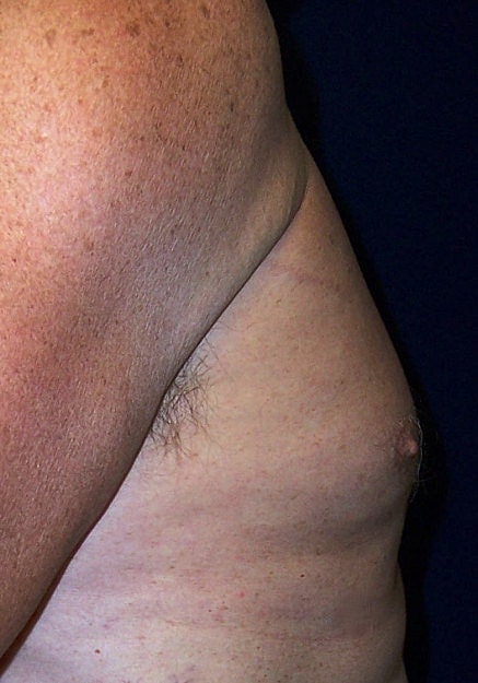 Male Breast Reduction Before & After