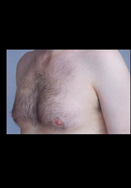 Male Breast Reduction Before & After