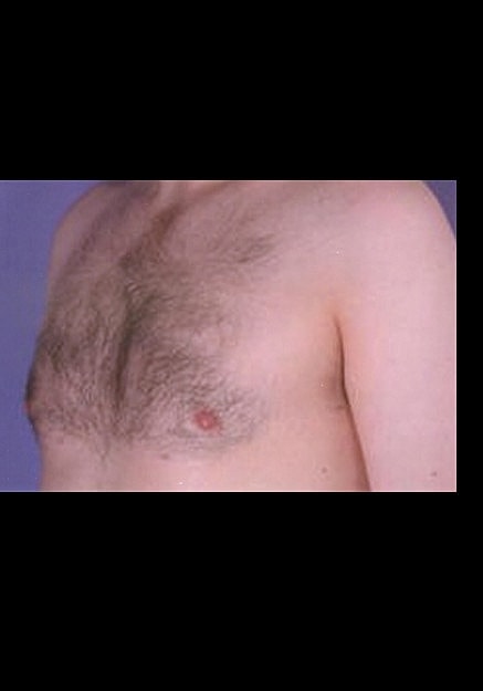 Male Breast Reduction Before & After