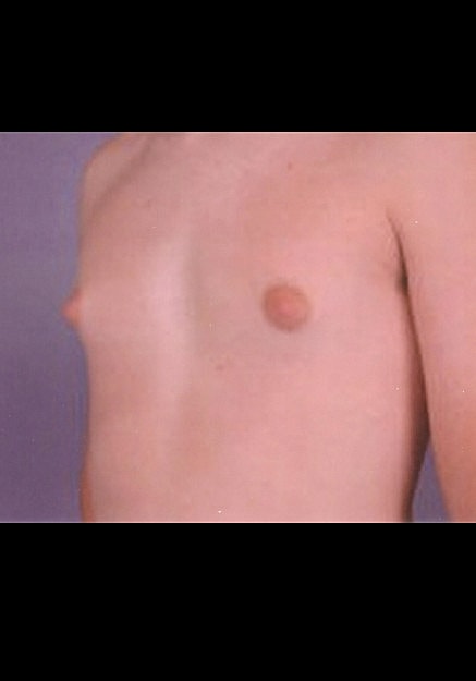 Male Breast Reduction Before & After