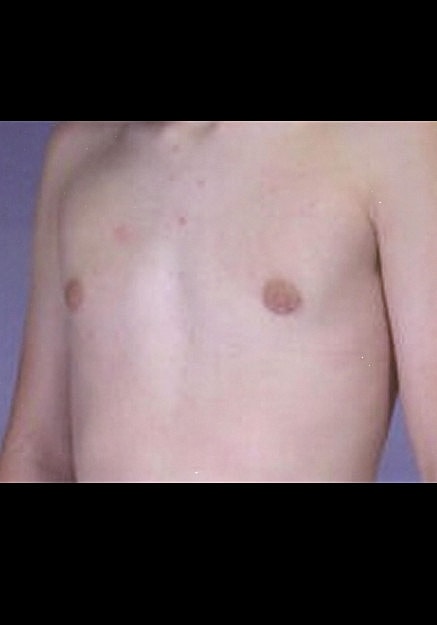 Male Breast Reduction Before & After