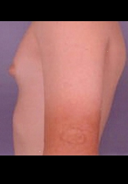 Male Breast Reduction Before & After