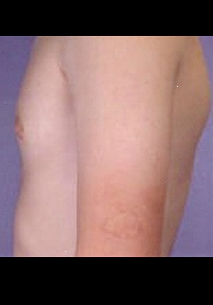 Male Breast Reduction Before & After