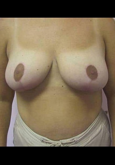 Breast Reduction Before & After