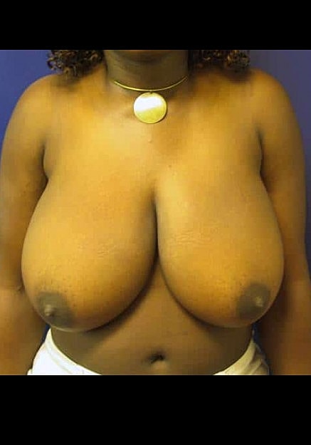 Breast Reduction Before & After
