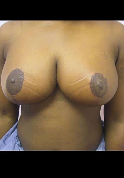 Breast Reduction Before & After