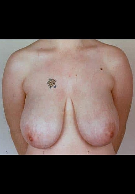 Breast Reduction Before & After