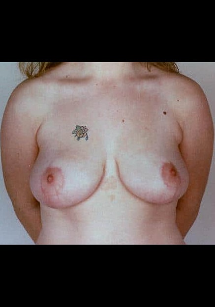 Breast Reduction Before & After