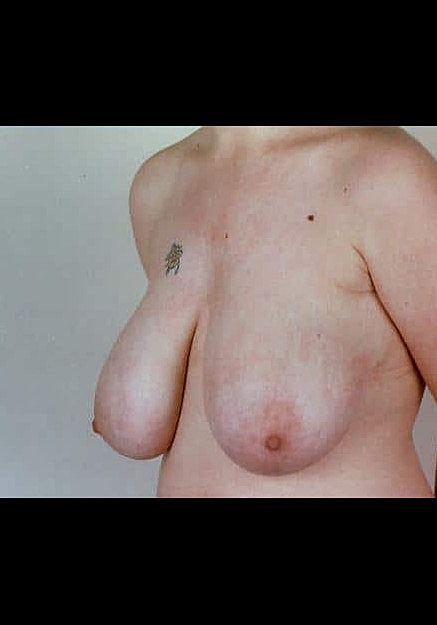 Breast Reduction Before & After