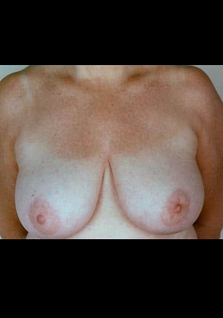 Breast Reduction Before & After