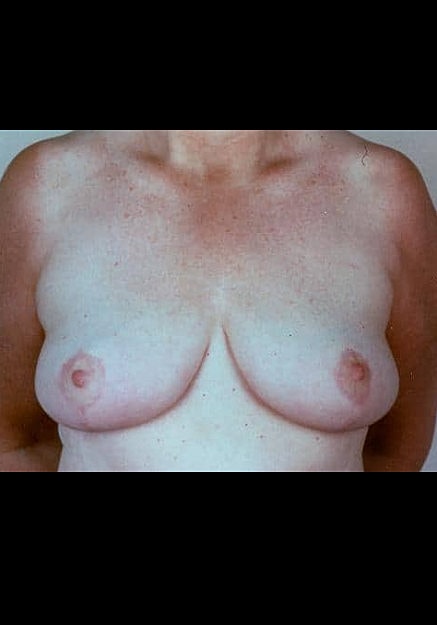 Breast Reduction Before & After