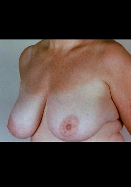 Breast Reduction Before & After