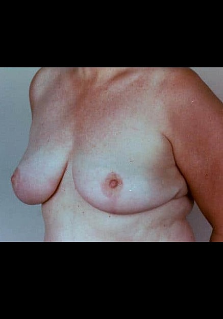 Breast Reduction Before & After