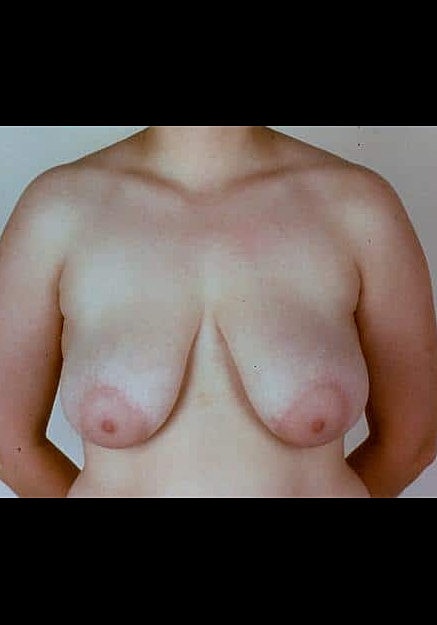 Breast Reduction Before & After