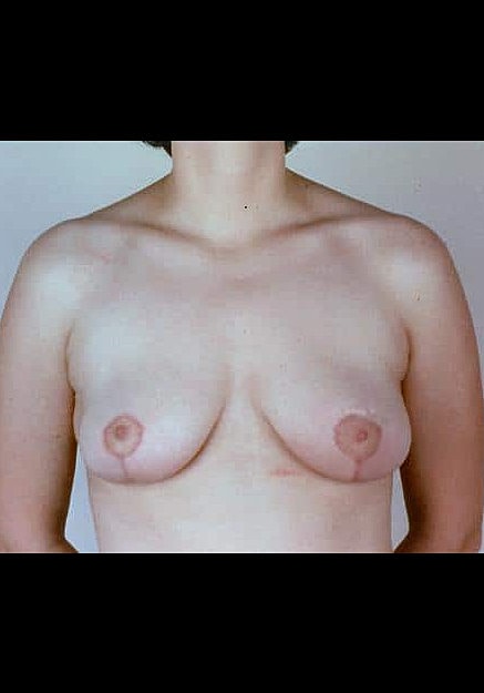 Breast Reduction Before & After