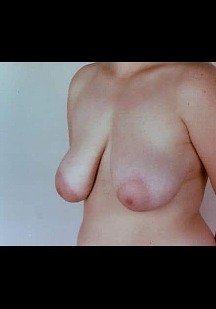 Breast Reduction Before & After