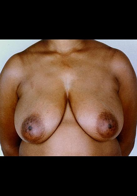 Breast Reduction Before & After