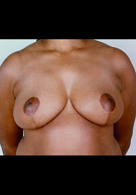 Breast Reduction Before & After