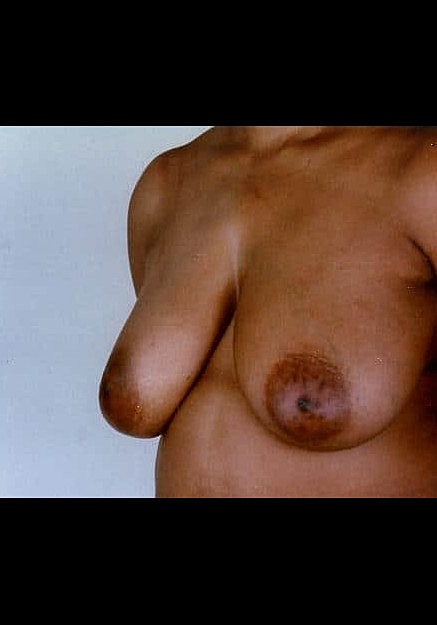 Breast Reduction Before & After