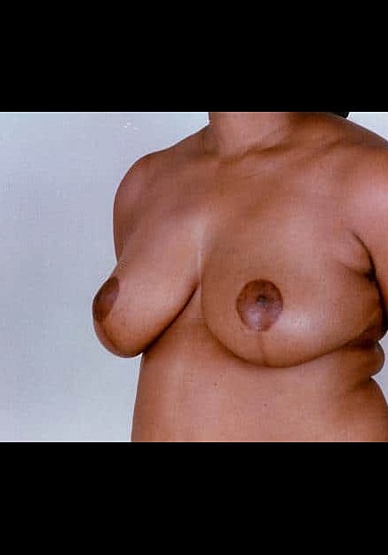 Breast Reduction Before & After