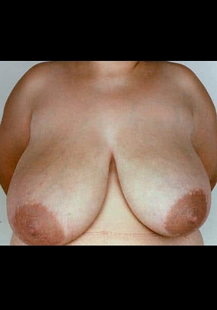 Breast Reduction Before & After