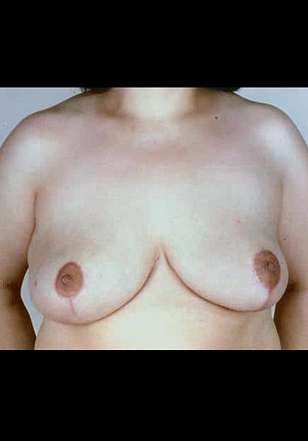 Breast Reduction Before & After