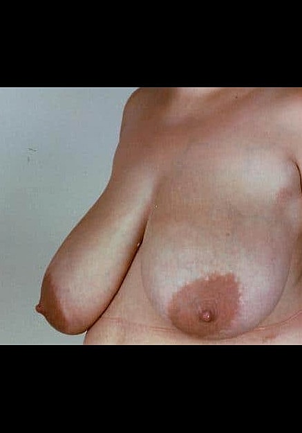 Breast Reduction Before & After