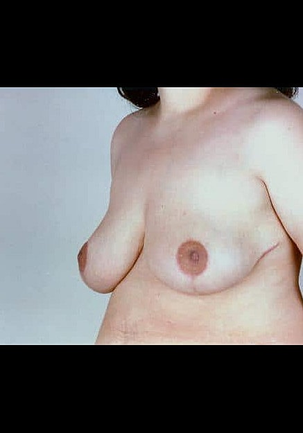 Breast Reduction Before & After