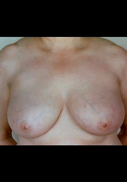 Breast Reduction Before & After