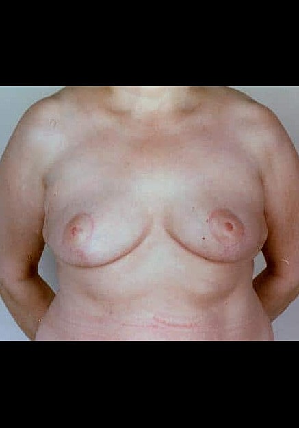 Breast Reduction Before & After