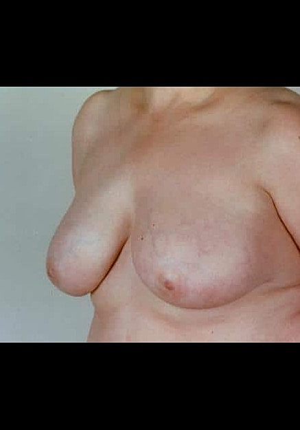 Breast Reduction Before & After