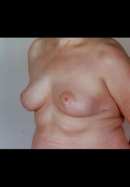 Breast Reduction Before & After