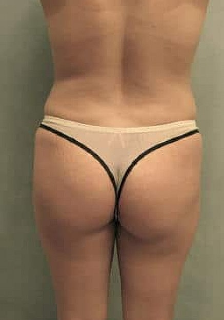 Brazilian Butt Lift Before & After