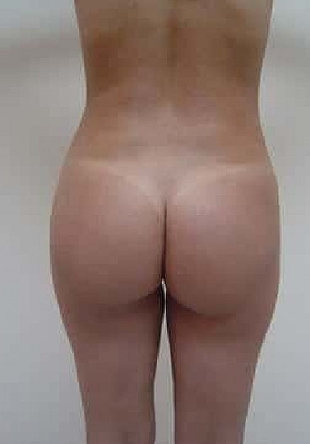 Brazilian Butt Lift Before & After