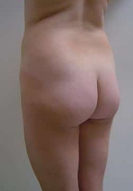 Brazilian Butt Lift Before & After