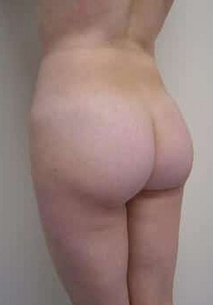 Brazilian Butt Lift Before & After