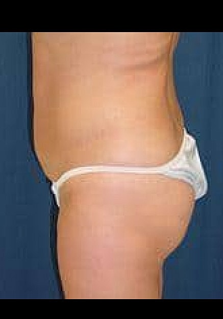 Brazilian Butt Lift Before & After