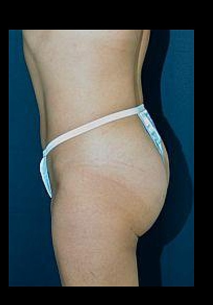 Brazilian Butt Lift Before & After