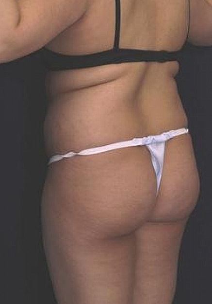 Brazilian Butt Lift Before & After
