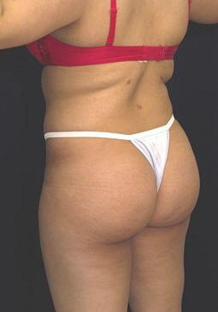 Brazilian Butt Lift Before & After