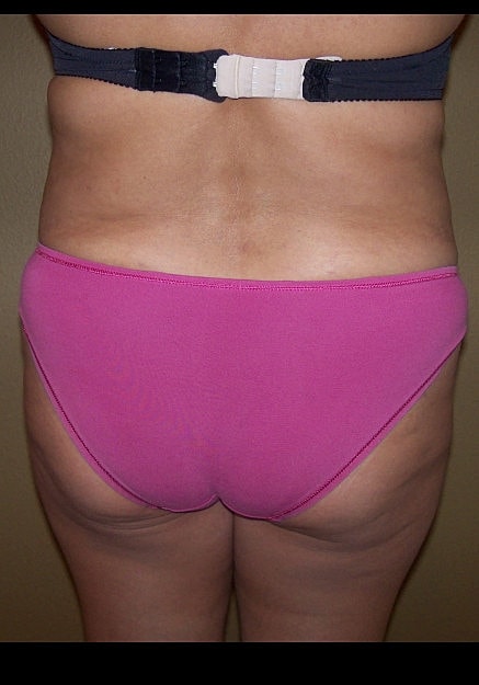 Brazilian Butt Lift Before & After