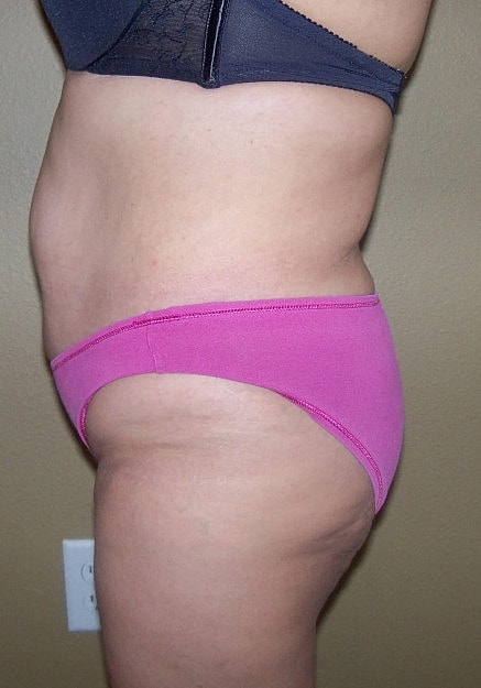 Brazilian Butt Lift Before & After