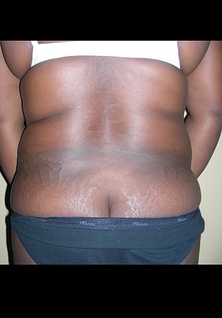 Brazilian Butt Lift Before & After