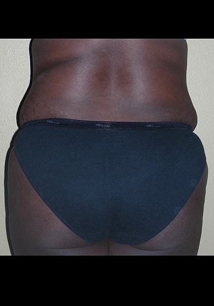 Brazilian Butt Lift Before & After