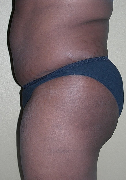 Brazilian Butt Lift Before & After