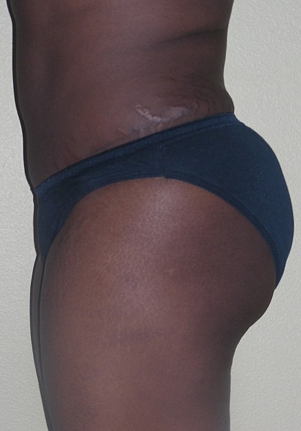 Brazilian Butt Lift Before & After