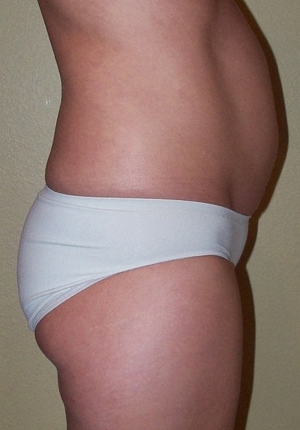 Brazilian Butt Lift Before & After