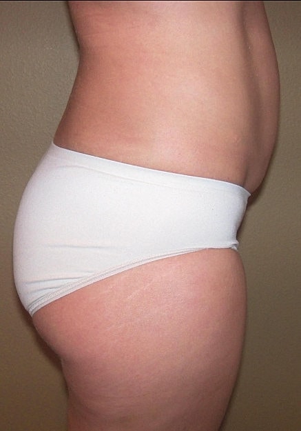 Brazilian Butt Lift Before & After