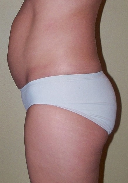 Brazilian Butt Lift Before & After